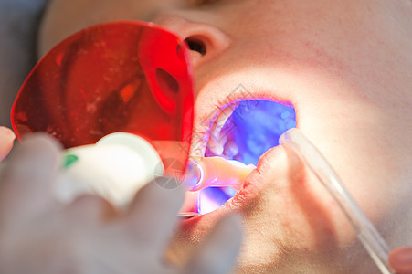 牙科 用紫外线向病人提供复合牙填充图片