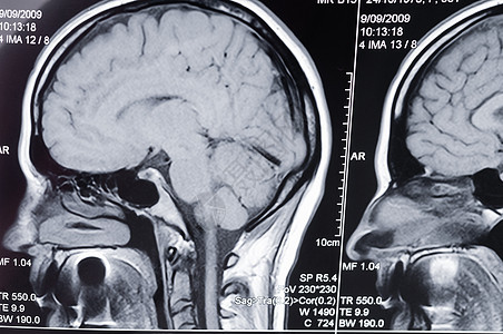 头部计算机轴心断层摄影扫描CAT测试诊断病人疾病x射线谐振轴向电脑放射科核磁共振图片