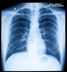 X Ray 人类胸前图像活力医院诊断身体医疗锁骨骨骼卫生肋骨射线图片