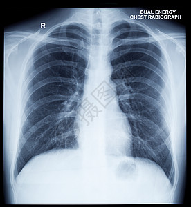 X Ray 人类胸前图像诊断锁骨医疗x射线射线胸部骨骼x光照相肋骨图片