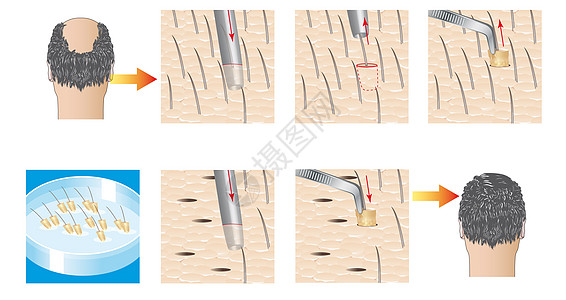 理发器官移植图片
