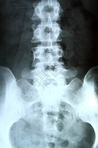 骨盆和脊柱的X光片药品保健手术解剖学柱子电影臀部放射科考试射线图片