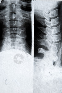 X光照片放射调查医生身体x光脊柱疾病扫描放射科软骨图片