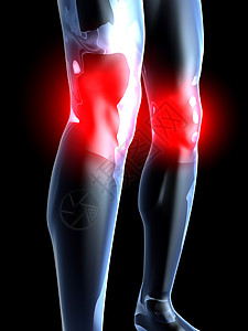 膝关节疼痛  解剖学伤害男性胫骨考试感染组织教育肌肉药品插图图片