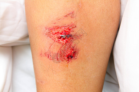 伤口痛苦划痕皮肤急救保健身体情况女孩女士清洁度图片