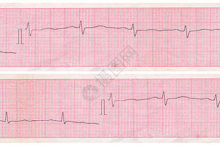 心电图 心脏分析计划图片
