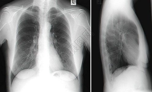 X Ray 人类胸前图像脊柱考试辐射诊断骨骼女士扫描卫生疾病实验室图片