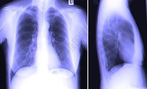 X Ray 人类胸前图像女性胸部辐射骨骼药品诊所实验室女士考试电影图片
