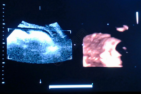 超声道胎儿新生怀孕极端主义者技术超声波药品母亲考试诊断生活图片