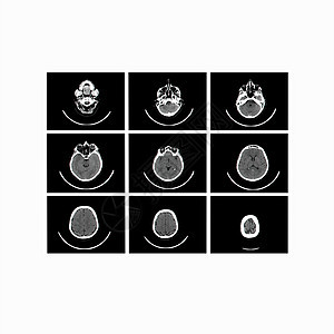 大脑X光图像计算断层摄影外科疾病手术诊断扫描测试辐射核磁共振考试药品图片