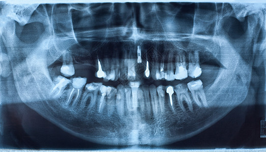 牙科X光x射线药品颅骨外科辐射诊断骨骼健康解剖学扫描图片