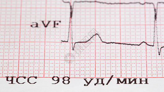 心电图频率梗死海浪时间脉冲心室思维癫痫监视器电脑图片