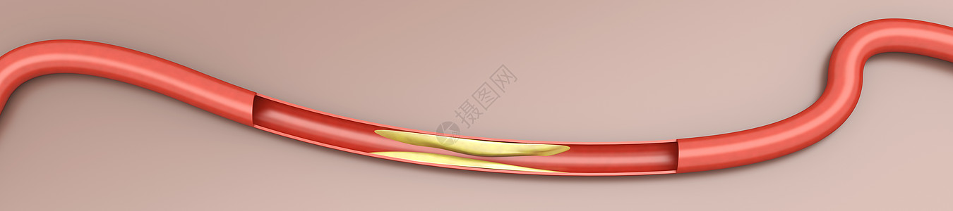 动脉硬化预防插图药品生活心脏病学解剖学宏观血栓血管健康图片