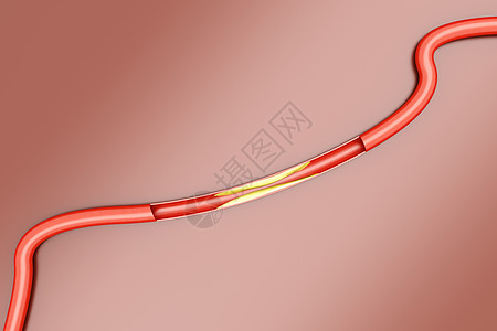 动脉硬化血管宏观生物学动脉心脏病学科学疾病预防健康有氧运动背景图片