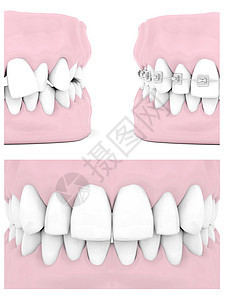 牙科牙套矫正金属牙医牙齿白色图片
