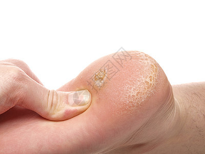 脚下干皮肤和骨老茧医生考试检查温泉工作室手指女性组织修脚图片