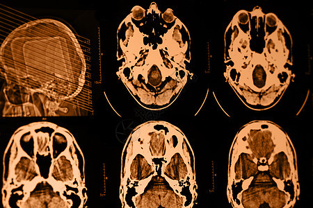 头骨CT和MRI扫描器断层先生x射线技术骨头辐射扫描核磁共振医院图片