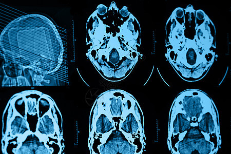头骨CT和MRI断层技术手术骨头骨骼放射科药品射线解剖学x射线图片