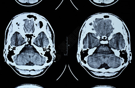 头骨CT和MRI药品骨头愈合考试技术辐射放射科诊断诊所核磁共振图片