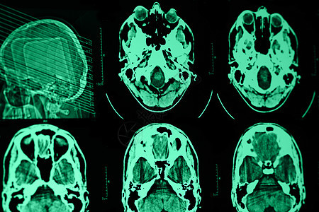 头骨CT和MRI科学核磁共振放射科照相骨头射线愈合身体诊断病人图片