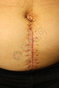 剖腹产手术后接缝生殖婴儿疼痛孩子缝针医院分娩母性生育皮肤图片
