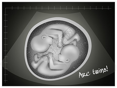 双胞胎超声波怀孕生长保健胚胎生活居住胎儿母性遗传学医疗图片
