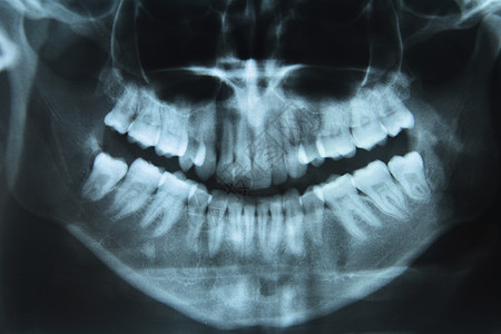 牙科X射线嘴巴检查图像医学考试牙周扫描人类牙龈颌骨图片