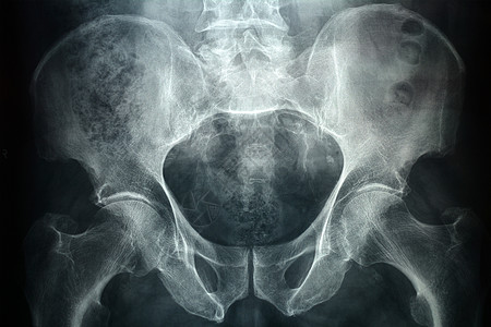白片透光医生重症医院股骨直肠骨科医学兽骨结构辐射图片
