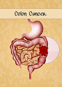 结结肠癌器官男人科学药品医疗附录插图男性丝带解剖学图片