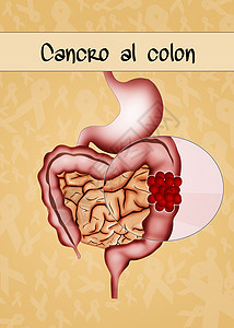 结结肠癌附录科学解剖学癌症器官男性男人药品腹部医疗图片