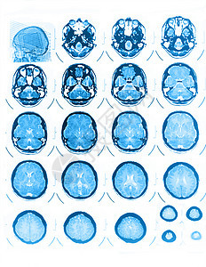头骨CT和MRI扫描器扫描辐射疾病核磁共振解剖学x光身体外科医院图片