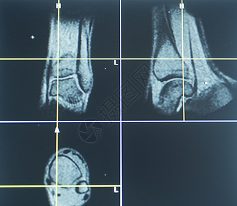 人体膝盖开放 MRI CT扫描x射线药品摄影检测成像医疗计算机疾病医生灯板图片