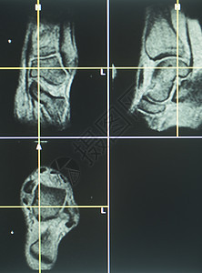 人体膝盖开放 MRI CT扫描身体死亡成像x射线癌症医疗疾病检测药品实验图片