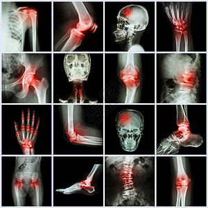 人体结关 关节炎和中风保健病人x光器官风湿情况卫生疾病解剖学男人图片