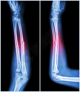 骨断裂轴前臂骨 正面和侧面视图手臂疼痛手腕前臂解剖学医院骨科情况x射线外科图片