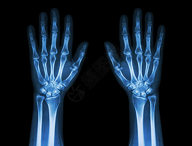 X光手前视 普通人手手臂棕榈男人前臂x射线手术骨骼调查医院疾病图片