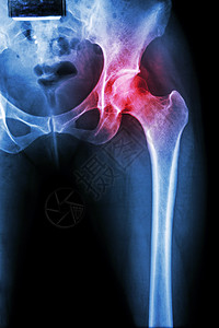 髋关节关节炎疾病髂骨髋臼男人骨盆屁股骨科x射线手术科学图片