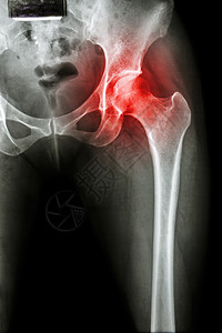 髋关节关节炎外科疾病骨科x光股骨诊断臀部骨骼射线髋臼图片