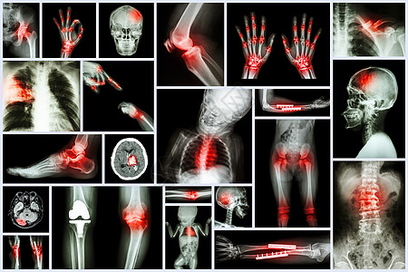 多个人体器官及骨科手术及多种疾病 肺结核 痛风 风湿性关节炎 脊椎病 骨折骨 中风 脑肿瘤等类风湿病人身体医院骨骼胸部颅骨解剖学图片