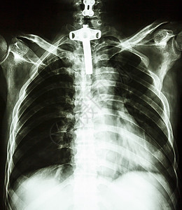 带有气管切开管的人体胸腔图片
