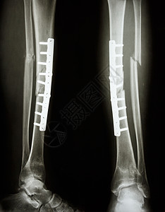 蒂比亚和纤维骨裂轴临床辐射手术医院骨科盘子创伤腓骨诊断科学图片