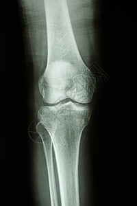 正常人的膝盖关节骨科考试骨骼创伤临床射线情况药品医师辐射图片