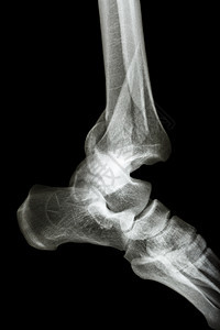 脚骨断裂和脚踝畸形;膝盖骨折图片