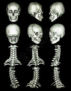 CT头骨扫描图片