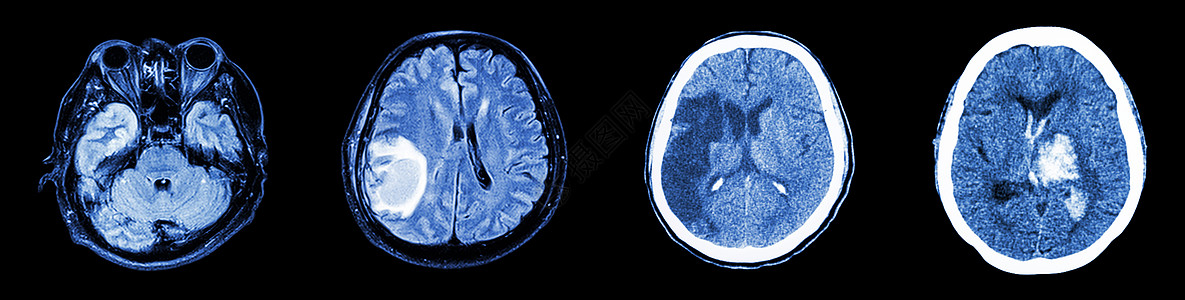 脑部和多种疾病右侧 正常大脑 脑肿瘤 肠道进化 内部跟踪出血的CT采集扫描男人中风神经外科科学断层增值税保健事故卫生图片