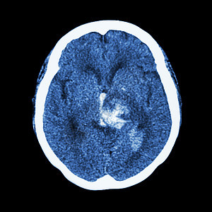 CT 脑部扫描 显示出血中风中风病人射线诊断创伤外科大脑脑血管情况手术图片