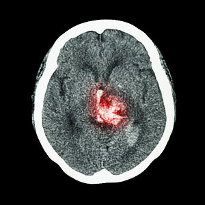 CT 脑部扫描 显示出血中风医生射线颅骨男人诊断医院出血外科卫生手术图片