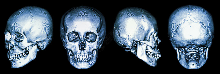 人体头骨和3DCT扫描收藏脑血管卫生保健身体解剖学外科射线药品事故图片