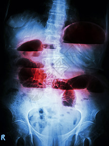 小型肠小阻塞疾病射线解剖学科学便秘医生肠胃保健卫生扫描图片