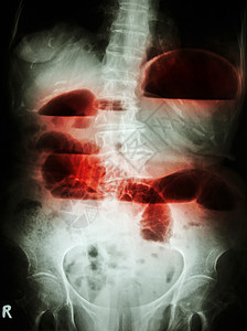 小型肠小阻塞病人手术外科射线身体卫生扫描医院腹痛解剖学图片